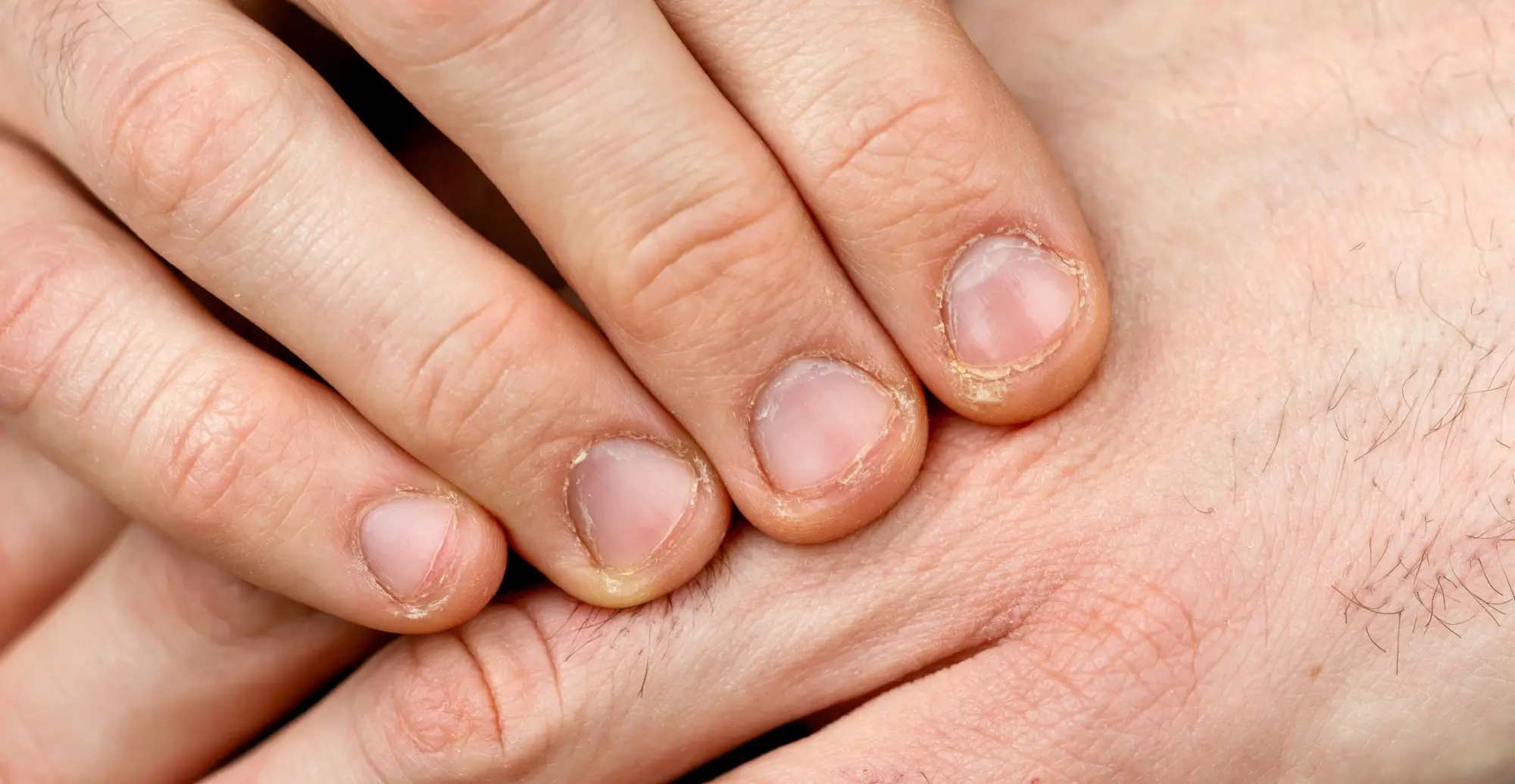 Člověk si překrývá ruce.