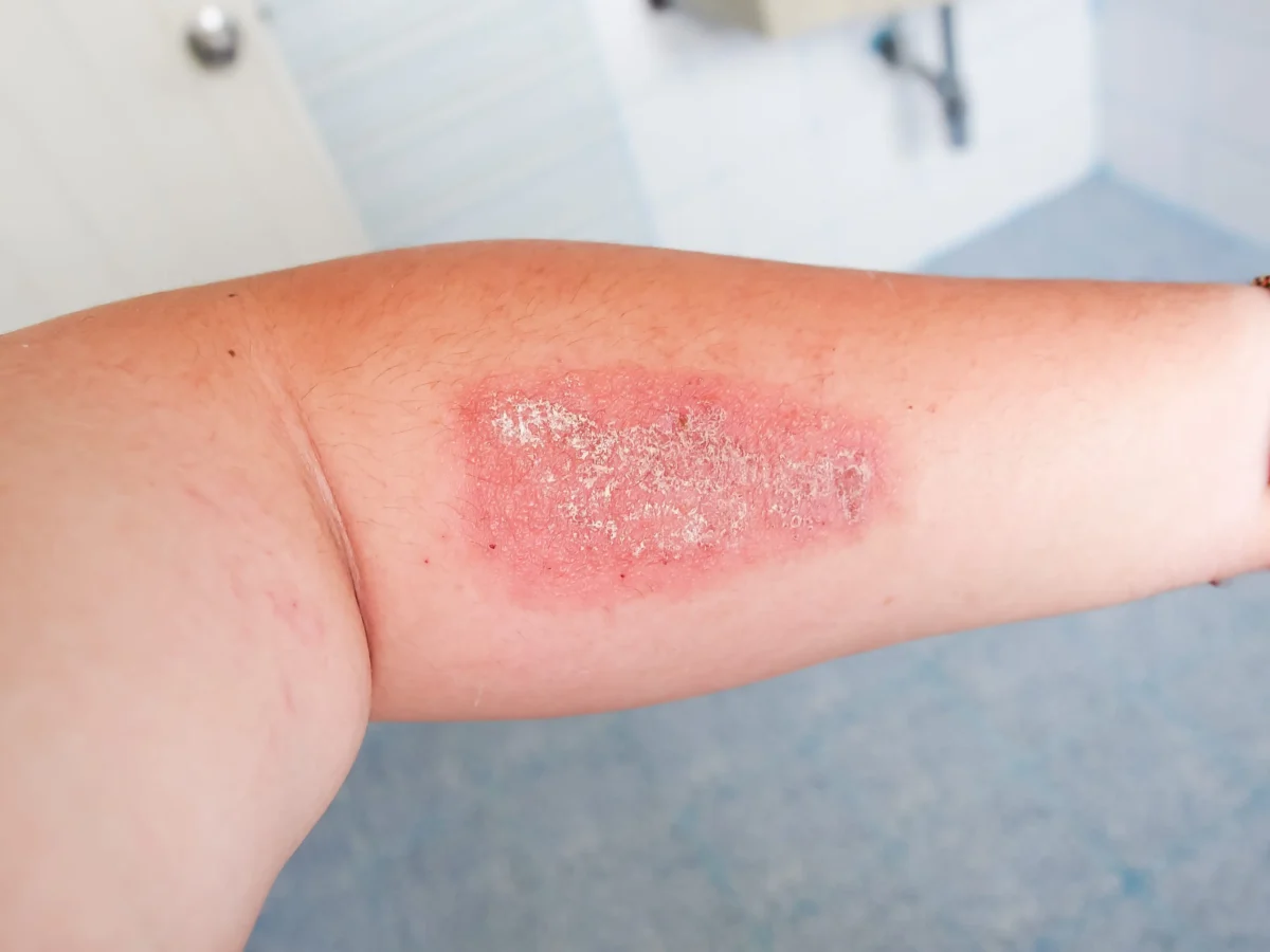 shutterstock_1123463879 1 | TVGURU.cz Close-up of an arm with a red, inflamed, scaly patch on the skin, resembling a rash or eczema.