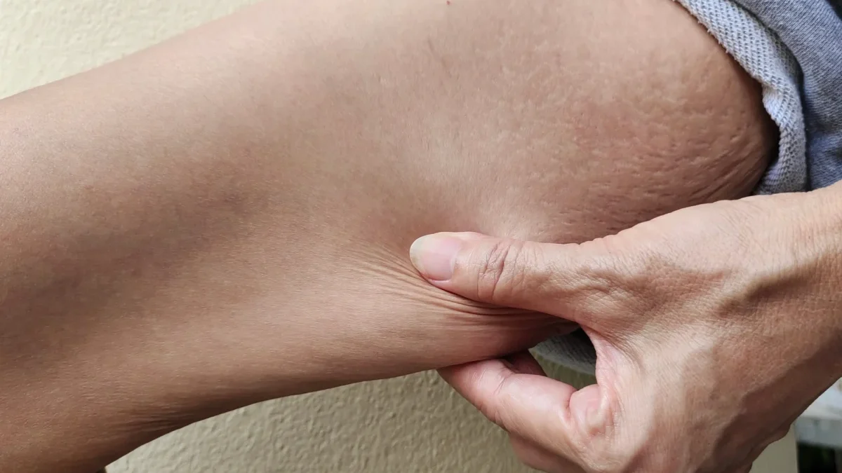 ruka tahající převislou kůži
