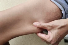 ruka tahající převislou kůži