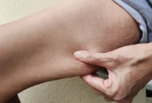 ruka tahající převislou kůži
