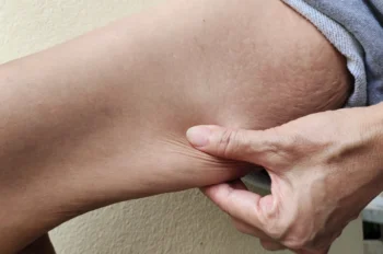 ruka tahající převislou kůži